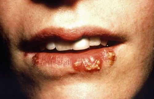 Lip Blisters - Causes, Symptoms, Treatment, Diagnoses, Prevention