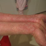 Mild Eczema