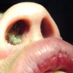 Nasal Polyps
