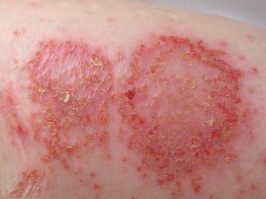 Nummular Eczema