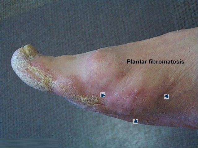 Plantar Fibromatosis Causes Symptoms Treatment Pictures Mri