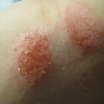 Scaly Skin Patches