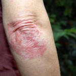 Scaly Skin Patches