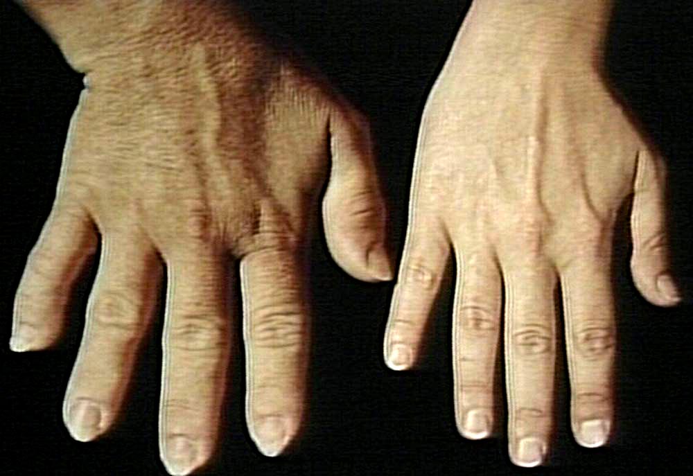Acromegaly People