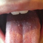 Bumps on Tongue