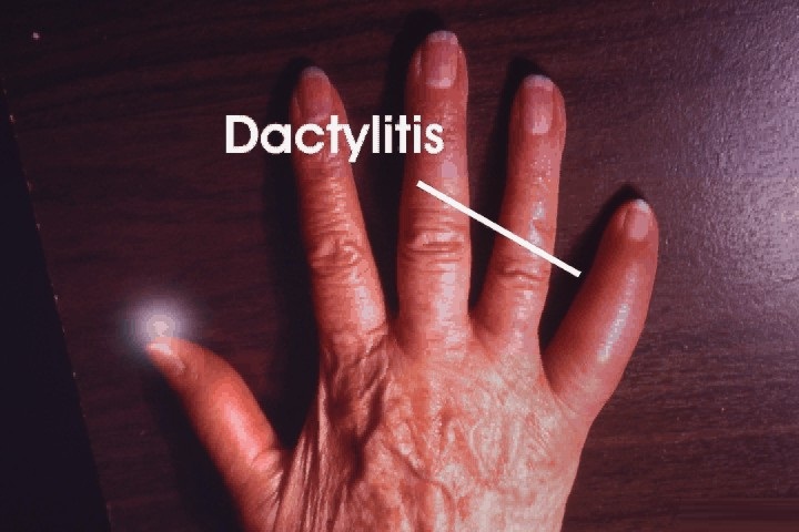 dactylitis