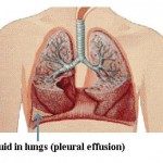 Fluid in The Lungs