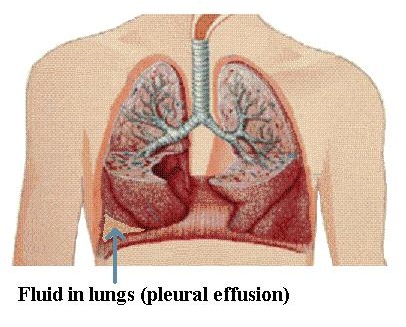 what does fluid in lungs sound like
