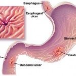 Gastric Ulcer