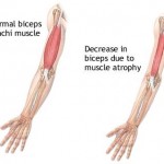 Muscle Atrophy