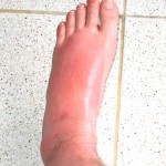 Swelling Feet