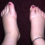 Swollen Feet