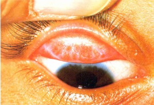 Trachoma