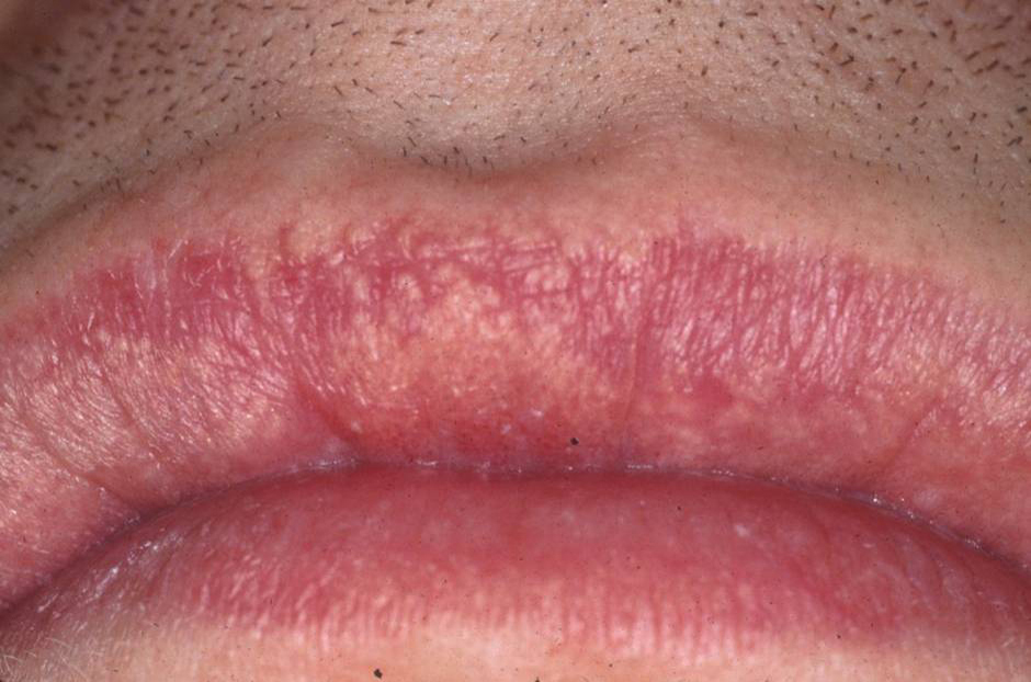Fordyce Spots Causes Symptoms Treatment Home Remedies Pictures