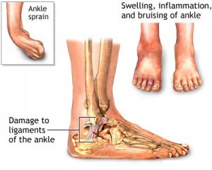 Ankle Injuries