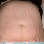 C Section Scar