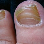 Fungal Nail Infection