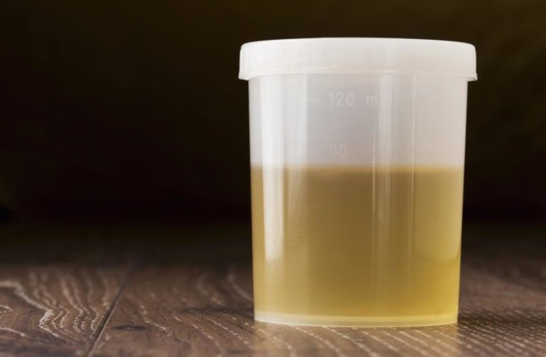 Cloudy Urine - Causes, Symptoms, Treatment, During Pregnancy | HealthMD