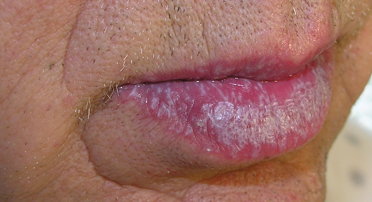 Lichen Planus Pictures Causes Symptoms Treatment Oral Healthmd My Xxx