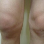 Swollen Knee