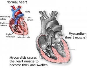 Viral Myocarditis