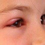 Eyelid Swelling