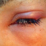 Eyelid Swelling