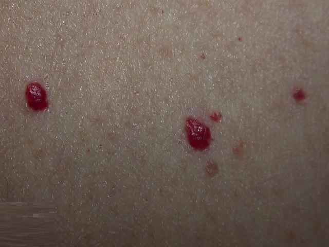 Cherry Angioma Pictures Causes Treatment Removal Symptoms Healthmd