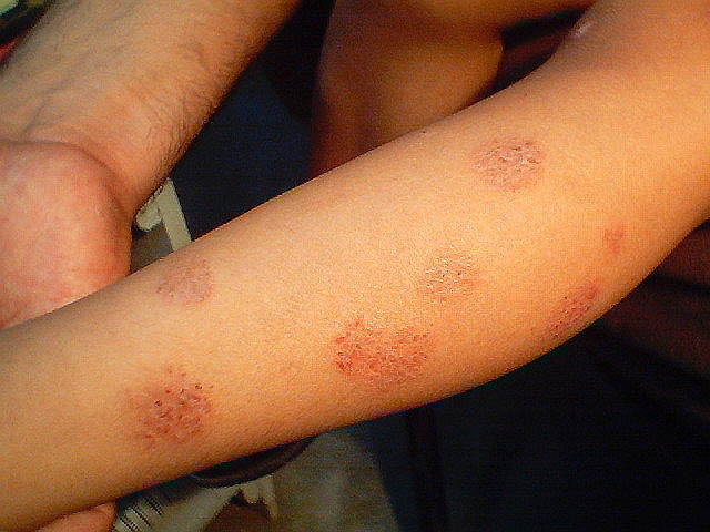 Nummular Dermatitis Symptoms Causes Pictures Treatment Home Remedies Healthmd