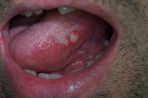 Canker Sore on Tongue