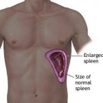 Enlarged Spleen