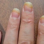 Fingernail Infection