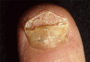 Fingernail Infection
