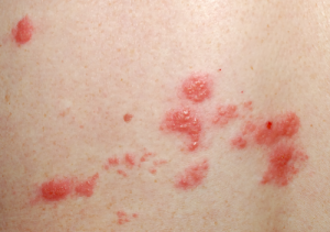 Red Itchy Bumps on Skin