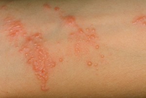 Red Itchy Bumps on Skin
