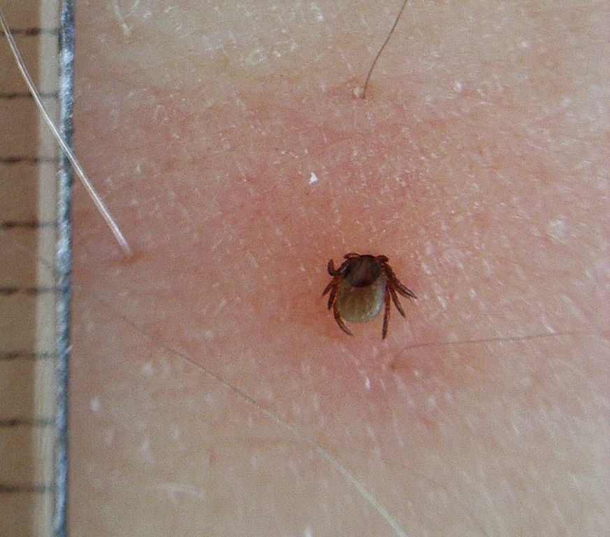 do tick bites itch and hurt and burn