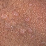 HPV Warts