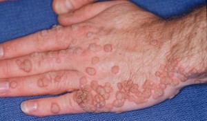 HPV Warts