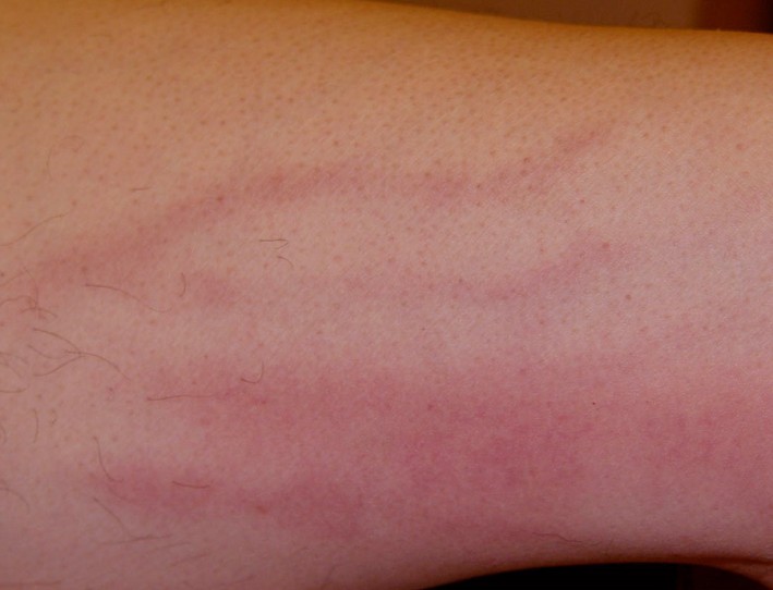 Thrombophlebitis Symptoms Pictures Causes Treatment Home Remedies