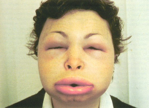 Angioedema Hereditary Symptoms Causes Pictures Treatment Healthmd 