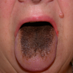 Black Hairy Tongue