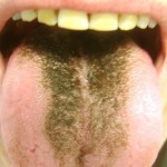 Black Hairy Tongue