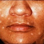 White Spots on Skin