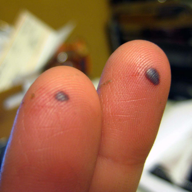 Blood Blisters 3 