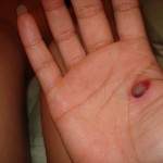 Blood Blisters