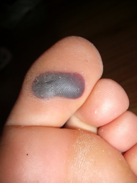 Blood Blisters - Causes, Symptoms, Treatment, Pictures, Prevention