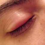 Swollen Eyelid