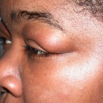 Swollen Eyelid