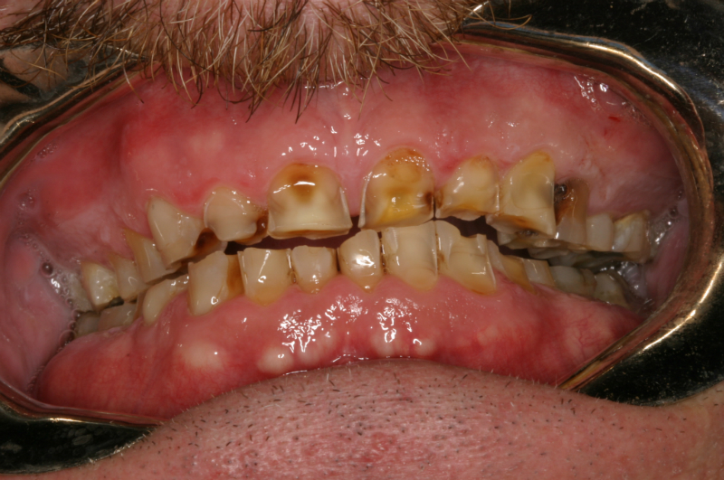 Rotten Teeth Pictures Symptoms Causes Treatment Healthmd