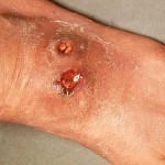 Skin Ulcer